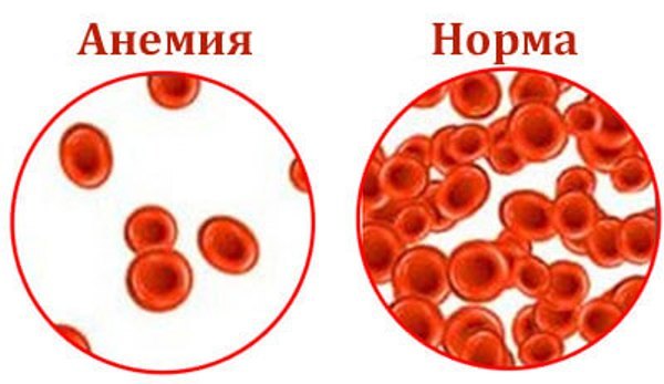 Гемолитическая анемия: причины и диагностика