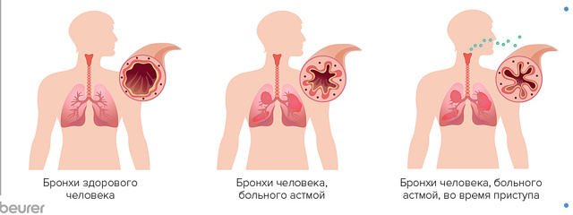 Как лечить бронхиальную астму?