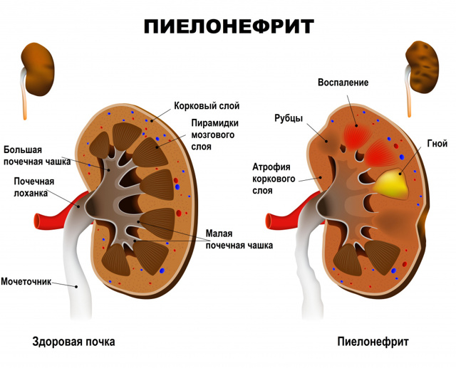 Острый пиелонефрит: симптомы и диагностика