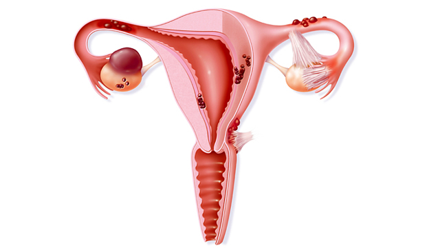 Мифы и факты об эндометриозе