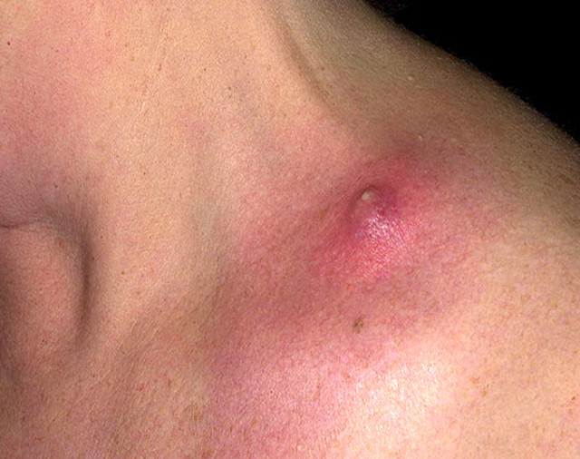 Гнойные воспаления кожи и подкожной клетчатки