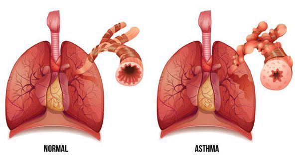 Лечение бронхиальной астмы у женщин