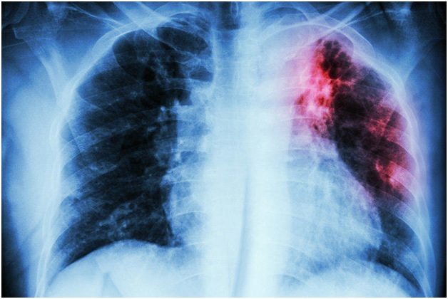 Общая информация и симптомы туберкулеза