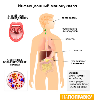 Инфекционный мононуклеоз у взрослых