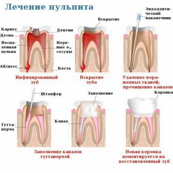 Болезни зубов: кариес, некариозные поражения, пульпит, периодонтит