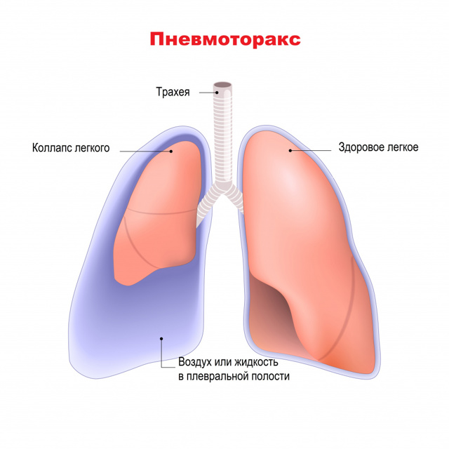 Симптомы туберкулеза: коварное заболевание и его диагностика