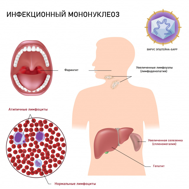 Вирус эпштейна-барр или инфекционный мононуклеоз