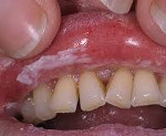 Кандидоз полости рта: этиология и патогенез