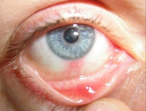 Лечение туберкулеза глаз