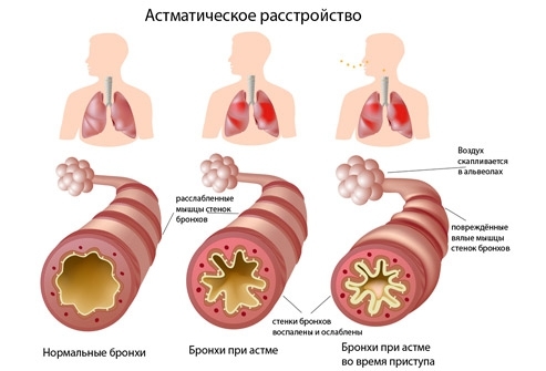 Осложнения на фоне бронхиальной астмы