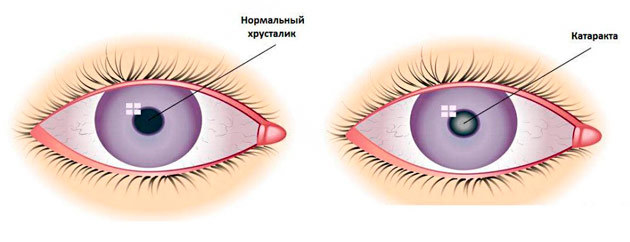 Что нужно знать о катаракте?