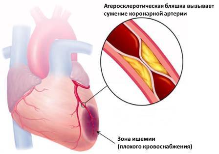 Лечение инфаркта и ишемической болезни сердца