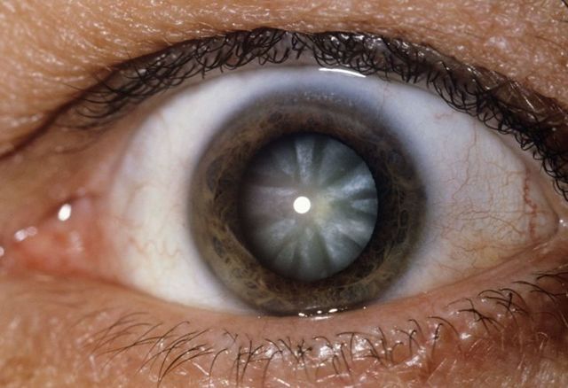 Катаракта, лечение катаракты