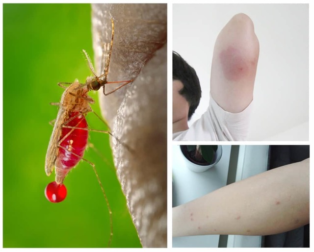 Симптомы аллергии на укусы насекомых