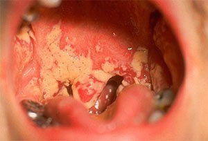 Кандидоз полости рта: симптомы и виды