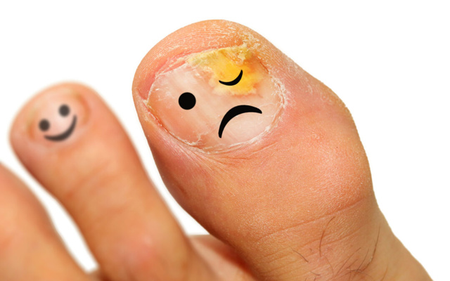 Кандидоз ногтей на ногах: симптомы и лечение