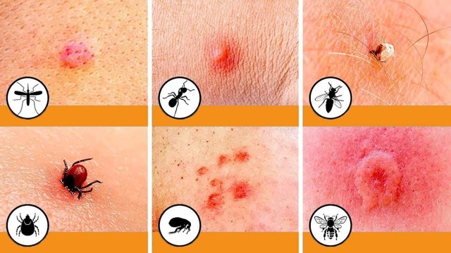Симптомы аллергии на укусы насекомых