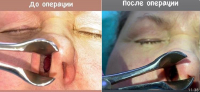 Фурункул слухового прохода и экзема ушной раковины
