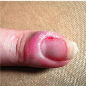 Как лечить ногти при кандидозе