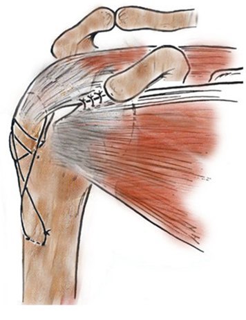 Перелом плечевой кости: правила первой помощи