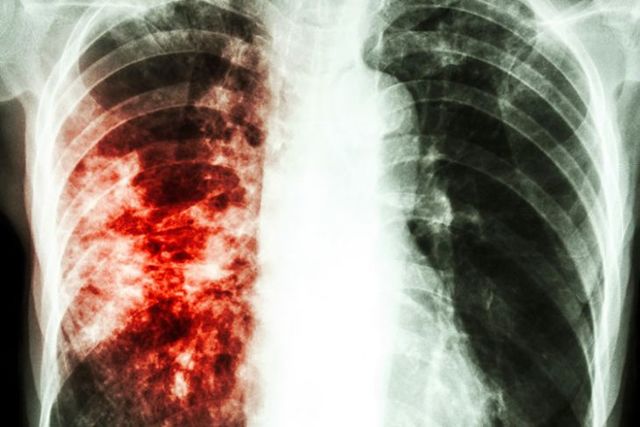 Народная медицина против туберкулеза кожи