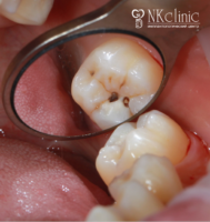 Болезни зубов: кариес, некариозные поражения, пульпит, периодонтит
