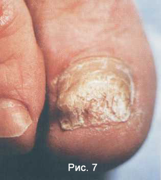 Кандидозный онихомикоз – грибок ногтей
