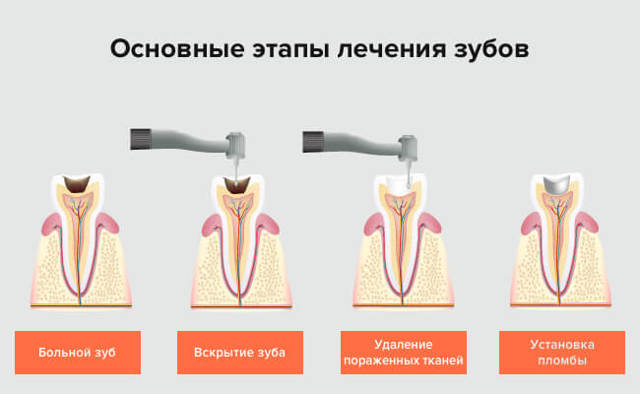 Лечение зубов