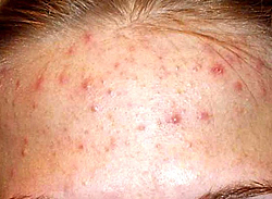 Болезни кожи: демодекоз
