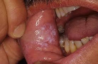 Кандидоз полости рта: этиология и патогенез