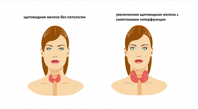 Значение анализа на гормоны щитовидной железы