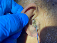 Фурункул слухового прохода и экзема ушной раковины