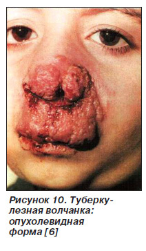 Симптомы туберкулеза кожи