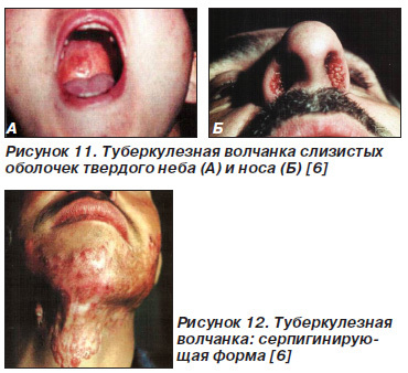Симптомы туберкулеза кожи