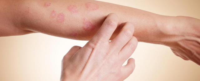 Аллергия и псориаз: сходство и различия