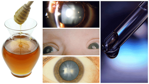 Опасные домашние способы лечения катаракты