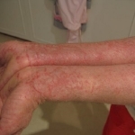 Аллергия и псориаз: сходство и различия