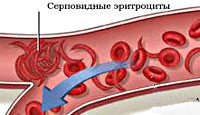 Серповидноклеточная анемия