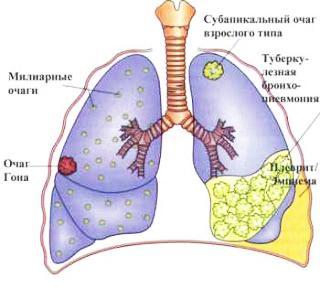 Симптомы запущенной стадии туберкулеза