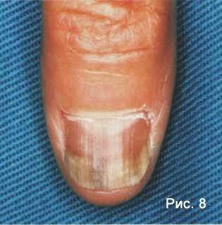 Кандидозный онихомикоз – грибок ногтей