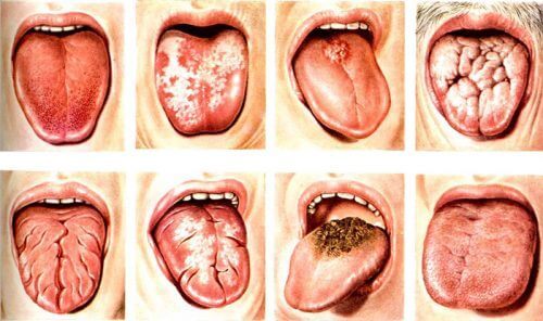 Кандидоз полости рта: причины